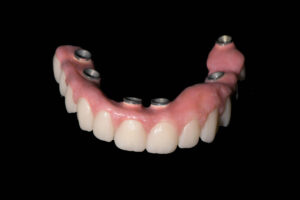 All-on-6 Fast-and-fixed All-on-4 Proteza punte dentara Cristina Rizea